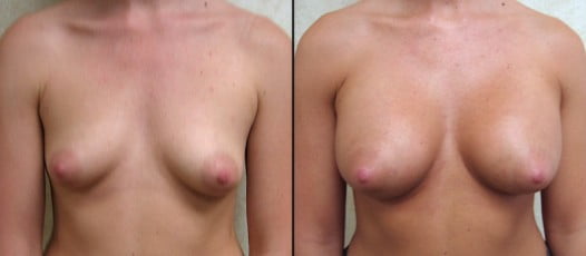 McLean, VA - Breast Augmentation Patient 1