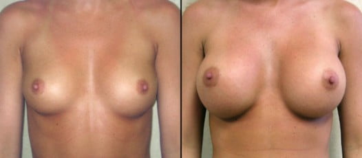 McLean, VA - Breast Augmentation Patient 2