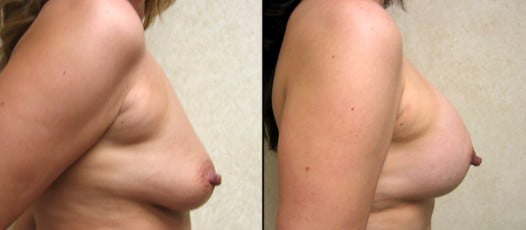 McLean, VA - Breast Lift with Implants Patient 1