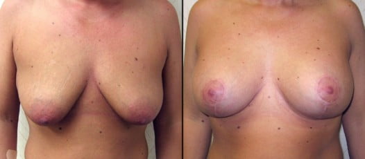 McLean, VA - Breast Lift with Implants Patient 2