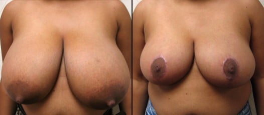 McLean, VA - Breast Reduction Patient 2