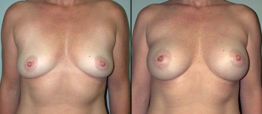 McLean, VA - Breast Augmentation Patient 3