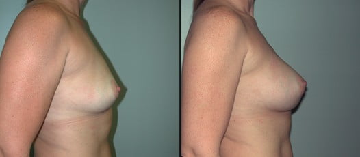 McLean, VA - Breast Augmentation Patient 3