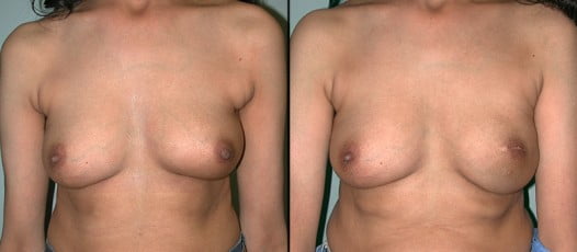 McLean, VA - Breast Reconstruction Patient 3