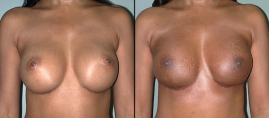 McLean, VA - Breast Reconstruction Patient 4