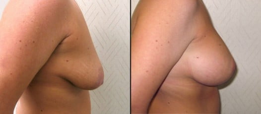 McLean, VA - Breast Lift with Implants Patient 2