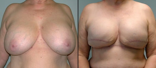 McLean, VA - Breast Reconstruction Patient 2