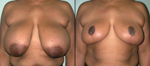 McLean, VA - Breast Reduction Patient 1