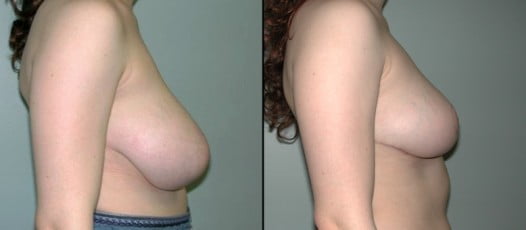 McLean, VA - Breast Reduction Patient 3