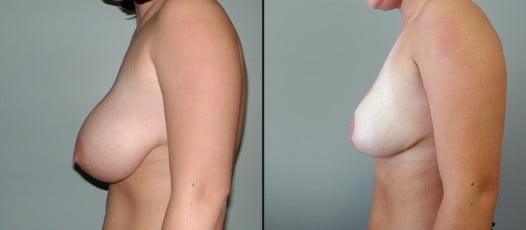 McLean, VA - Breast Reduction Patient 5