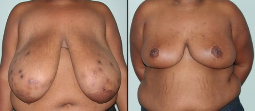 McLean, VA - Breast Reduction Patient 6