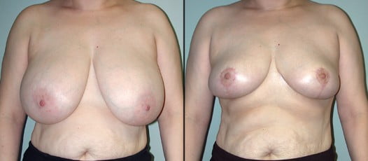 McLean, VA - Breast Reduction Patient 7
